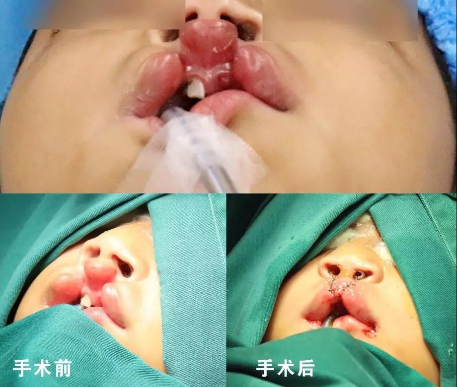 唇腭裂盡早治療消除孩子自卑心理，快樂成長！